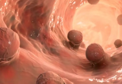 Polyp đại tràng- những vấn đề chung